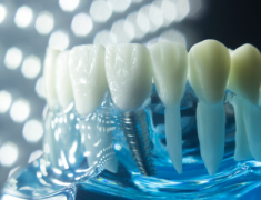 种牙告别万元时代 欧美品牌集采价遭腰斩