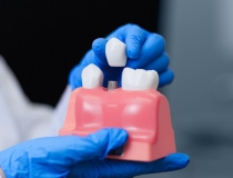 降价后的种植牙服务将于3月下旬到4月中旬落地实施